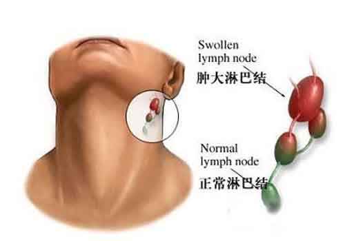 淋巴癌能治愈吗(什么人容易得淋巴癌)