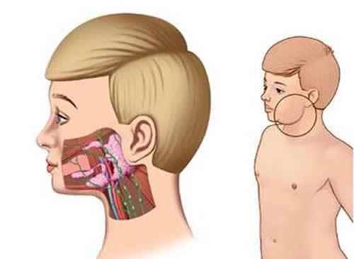 流行性腮腺炎隔离时间(流行性腮腺炎隔离后如何护理)