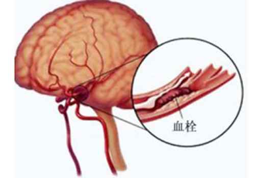 脑血栓能治好吗(什么人容易得脑血