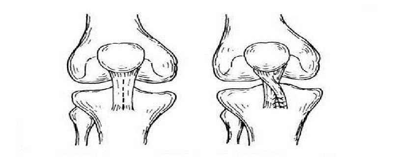 髌骨半脱位的原因(髌骨半脱位不治