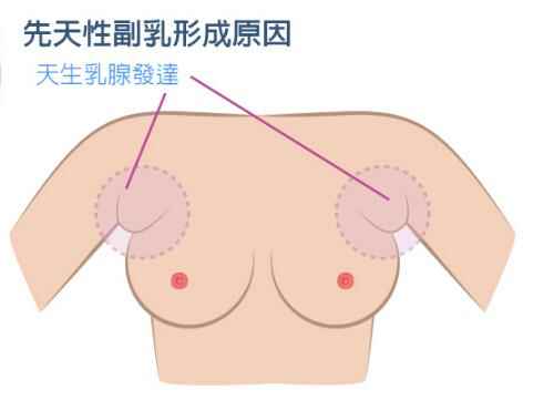 副乳的危害(副乳的危害有哪些)