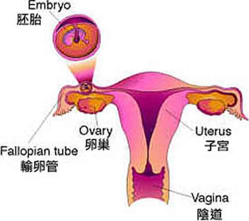 什么是宫外孕(宫外孕怎么办)