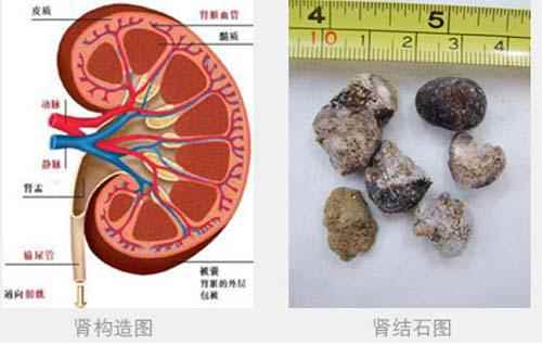 肾结石需要做手术吗(肾结石手术后