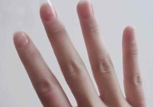 林赛氏指甲的典型图片(林赛氏指甲图片和症状)