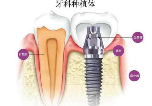 种植牙的危害有哪些(出血种植牙齿