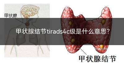 甲状腺结节tirads4c级是什么意思(甲状腺结节ti一rads4c级)