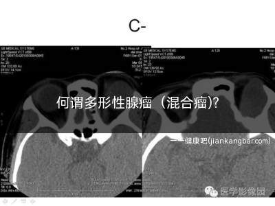 何谓多形性腺瘤（混合瘤)(头颈部及皮肤混合瘤可以恶变)