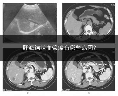 肝海绵状血管瘤是什么原因(肝海绵状血管瘤手术后遗症)