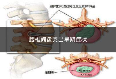 腰椎间盘突出早期症状(腰椎间盘突出症的病人可因)