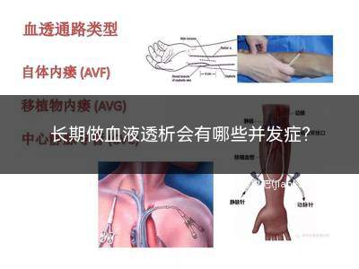 长期血液透析后有哪些并发症(维持性血液透析并发症及其防治)