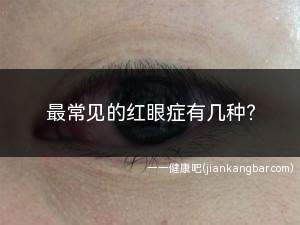 红眼病最开始症状是什么样子(红眼病有什么预防方法)