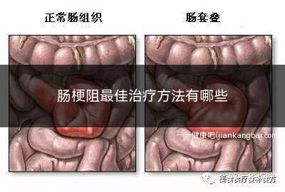 肠梗阻最佳治疗方法有哪些(肠梗阻最佳治疗方法)