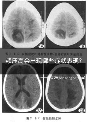 颅压高会出现哪些症状表现(出血性脑血管疾病或缺血性)