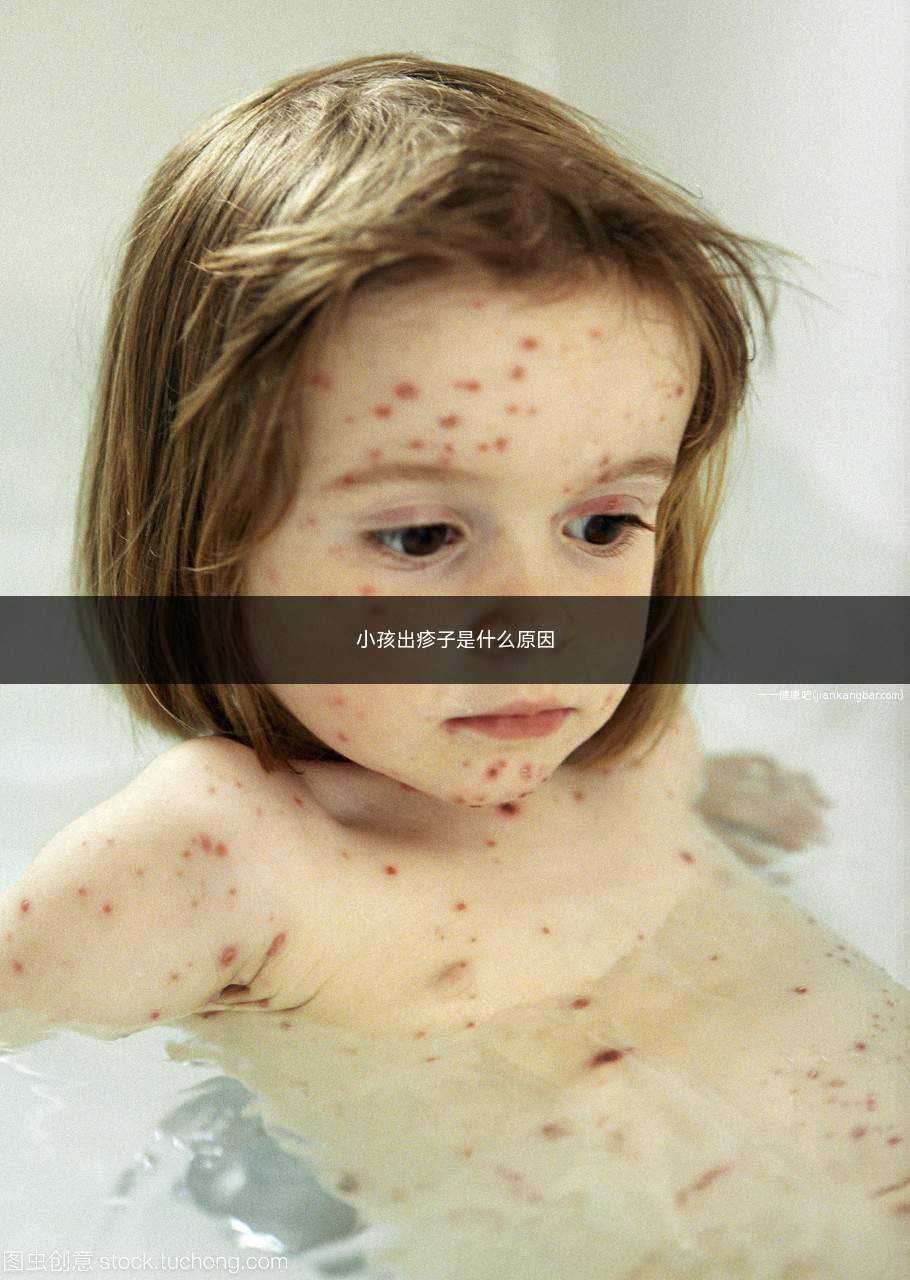 小孩出疹子是什么原因(宝宝发烧后出疹子应该是幼儿急疹了)